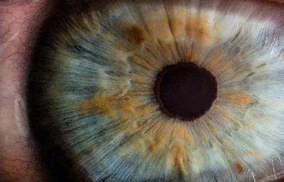A new risk? Macular Degeneration